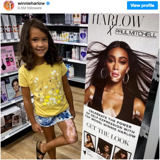 Young girl with vitiligo standing next to a poster of Winnie Harlow